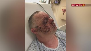 ‘Everything was over’ Victim of devastating fireworks accident warns others 2 years later  WPXI [upl. by Sisi]