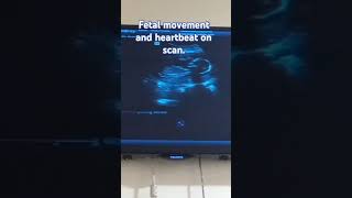 Fetal development and heartbeat 😍😍on scan fetal fetaldevelopment [upl. by Riek871]