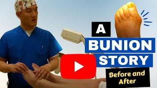 A Bunion story Before and after  Florida Podiatrist toppodiatrist [upl. by Naniac]