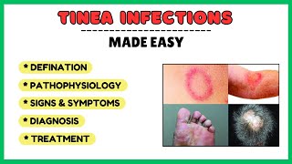 Tinea infection fungal skin infection types risk factors pathophysiology diagnosis treatment [upl. by Ledda366]