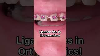 Types of ligation with Braces  Tooth Time Family Dentistry New Braunfels Texas [upl. by Aymik149]