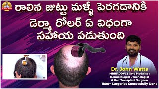 Derma Roller For Hair Growth  డెర్మా రోలర్ ఉపయోగించే విధానం  DrJohn Watts  Trichos [upl. by Gamin]