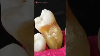 Hidden Tooth Cavity asmr dentist [upl. by Annoiek]