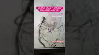 The placement of Contour device Minimally invasive Procedure for Basilar Top Aneurysm dralokkudiya [upl. by Eisse]