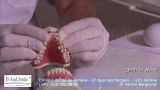 orthodontie des classes II avec Invisalign  Les Dents en Avant [upl. by Aretina973]