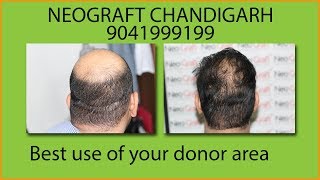 Full head hair transplant weak donor areaHair Transplant Chandigarh [upl. by Oiramej]