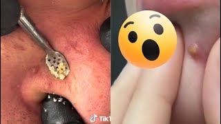 Ultimate Pimple Popping Compilation 2024  Satisfying Blackhead amp Acne Removal  Oddly Satisfying [upl. by Ynagoham]