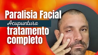 Tratamento da Paralisia facial com Acupuntura e Auriculoterapia [upl. by Hach]