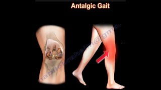 Painful Gait Antalgic Gait painful gait [upl. by Atinor]