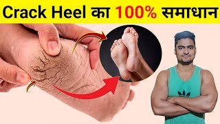 Crack Heel Home Remedy l Cracked Heels Treatment l Crack Heel Cream l Crack Heel Cure in Hindi l [upl. by Nnek]