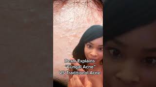 Why those tiny bumps arent Fungal Acne [upl. by Kissee428]