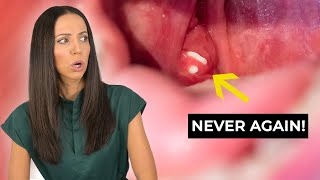 How to PREVENT Tonsil Stones [upl. by Liba]