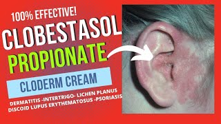 CLOBESTASOL PROPIONATE CREAM REVIEW [upl. by Sivek]