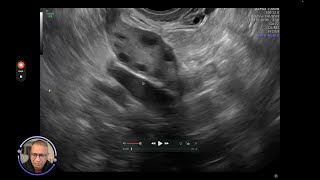 antral follicle count [upl. by Bogart]