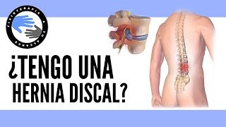 Como saber si tienes una hernia discal lumbar  Signos y diagnóstico de una hernia de disco [upl. by Nnayllehs331]