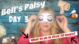 Bells Palsy Day 3 [upl. by Donaghue]