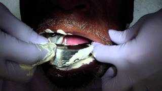 Removable Denture Clasp Repair Part 2  Alginate Pickup Impression [upl. by Darice824]