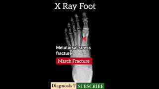 March Fracture  X Ray Foot  Diagnosis   Radiology [upl. by Ellesor758]