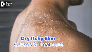 Dry itchy skin all over body Causes Diagnosis Treatment  Dr Rashmi Ravindra  Doctors Circle [upl. by Ethbin]