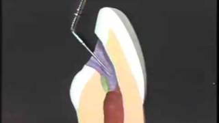 Endodontic Cavity Preparation [upl. by Kola990]