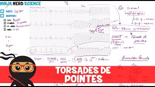 Rate and Rhythm  Torsades de Pointes [upl. by Bez]