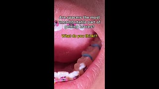 What Are Orthodontic Separators Spacers Tooth Time Family Dentistry New Braunfels Texas [upl. by Einhpad]