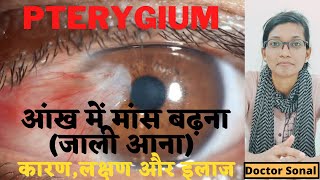 What is Pterygium in Hindi Treatment and Surgery Options  Dr Sonal [upl. by Inait]