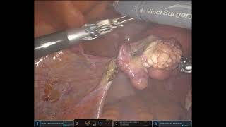 Cervical fibroids TLHBSO [upl. by Maibach]