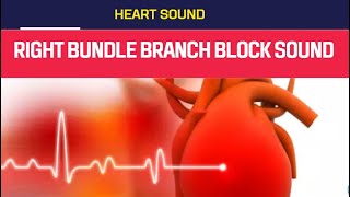 Right Bundle Branch Block Murmur sound Right Bundle Branch Block [upl. by Nwonknu]