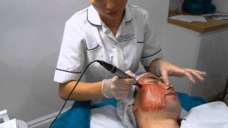 DERMAPEN Skin Needling For Acne Scarring [upl. by Ahron656]