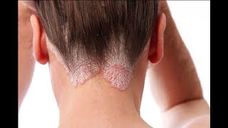 How to Treat Scalp Scabs [upl. by Maletta]