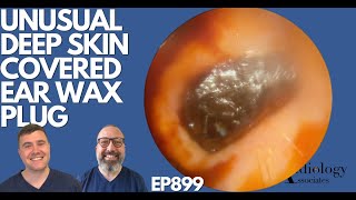 UNUSUAL DEEP SKIN COVERED EAR WAX PLUG  EP899 [upl. by Iain]