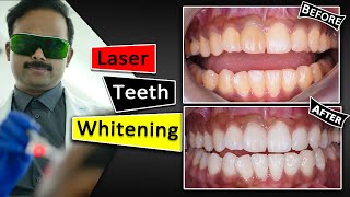 Teeth Whitening With Laser  Fastest amp Safest way [upl. by Linden]