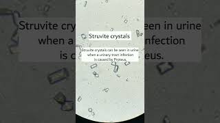 Struvite crystals under microscope seen when UTI caused by proteusmicroscopy urinalysis [upl. by Cutcliffe]