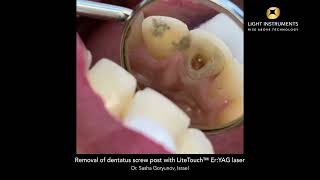 Removal of dentatus screw post with LiteTouch™ ErYAG laser [upl. by Leitao]