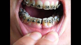 Bracesretainersbrackets  before and after timelapse 36 yr old [upl. by Euqinobe]