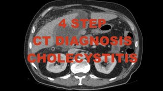 4 step diagnosis  Acute Cholecystitis on CT scan  case review with differential diagnoses [upl. by Leonardi]