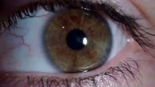 Nistagmus rotatorio  Rotary Nystagmus [upl. by Lednew]