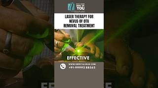 Laser Therapy for Nevus of OTA Removal Treatment  Nevus of OTA Treatment in Delhi  Dr PK Talwar [upl. by Malcom525]