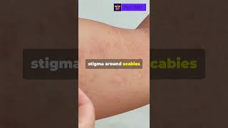 Dont Ignore That Itchy Rash Scabies Alert 🚨 [upl. by Aelgna]