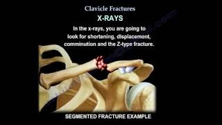 Clavicle Fractures  Everything You Need To Know  Dr Nabil Ebraheim [upl. by Selestina]