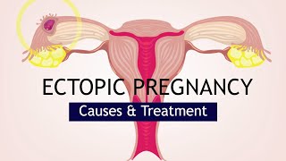 Ectopic Pregnancy Causes and Treatment [upl. by Ahsele]