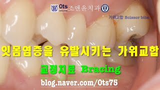 잇몸염증을 유발하는 가위교합  교정치료 Scissor bite causing gum inflammation  Bracing [upl. by La]