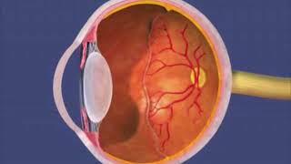 Animation Retinopathy of Prematurity [upl. by Stauffer]