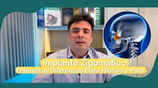 Implante Zigomático Entenda as Diferenças Entre Híbrido e Puro [upl. by Ained]