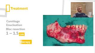 Ameloblastoma Dr MuhyAldeen Tutunjy [upl. by Nyla102]