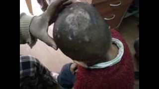 Scalp Eczema cured By Homeopathy DrRavi Singh [upl. by Ahsinrac]