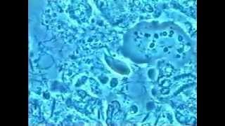 7 Kyste amibe trophozoites amibes globules blancs et Trichomonas dans les parodontites [upl. by Stenger107]