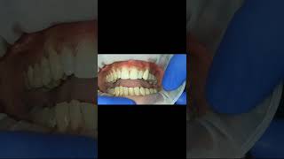 Molar implant PMMA milled bridge 40 micron occlusal clearance  with basal implants [upl. by Hackney]