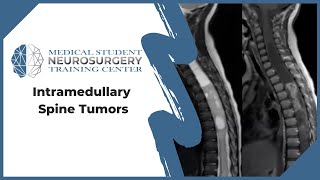 Intramedullary Spine Tumors [upl. by Aremus]